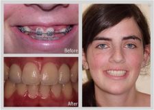 Front Tooth Implant Crowns