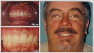 before and after of cosmetic crowns