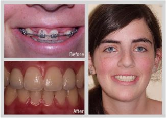 before and after of woman with dental implants