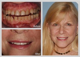 before and after of cosmetic veneers