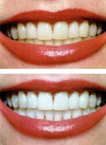 before and after from cosmetic teeth whitening