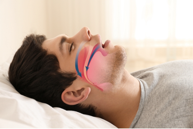diagram showing how sleep apnea occurs
